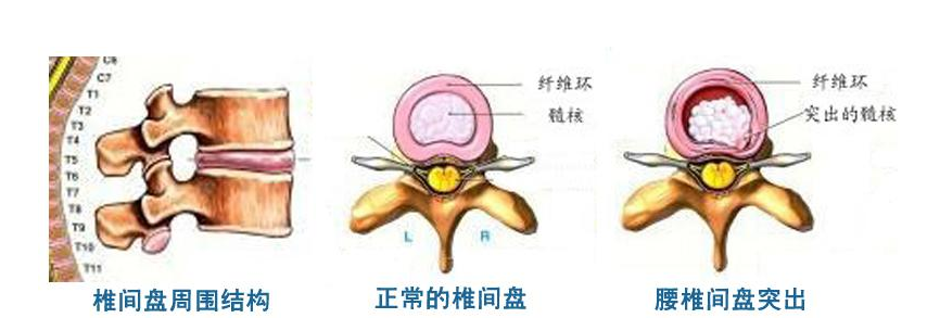 腰椎间盘突出