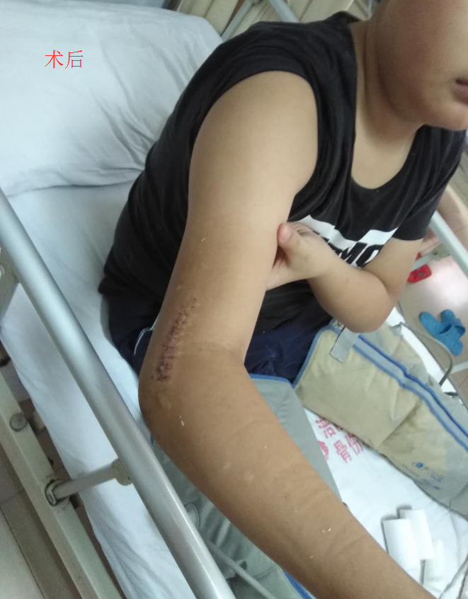 患者罗**,右手肘内翻畸形,术后右手功能恢复正常,极大提高了生活质量.