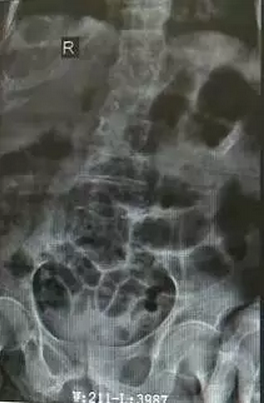 脊柱科成功完成一例92岁高龄老人椎体成形术